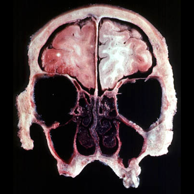 coupe anatomique coronale antérieure. Elle passe par l'étage antérieur de la base du crâne, les fosses nasales et les orbites.