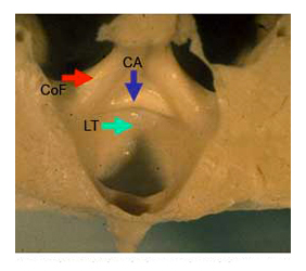 coupe sagittale Ventricule 3