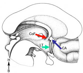 coupe sagittale Ventricule 3