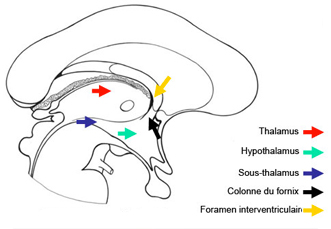 coupe sagittale Ventricule 3