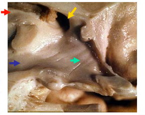 coupe sagittale Ventricule 3