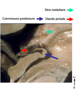 coupe sagittale Ventricule 3