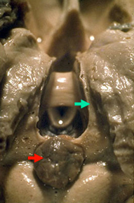 photographie Ventricule 3 vue postero superieure