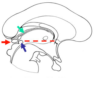 coupe sagittale Ventricule 3