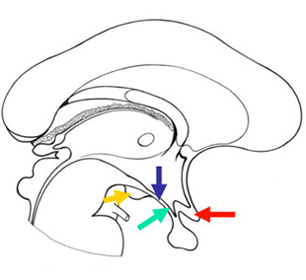 coupe sagittale Ventricule 3