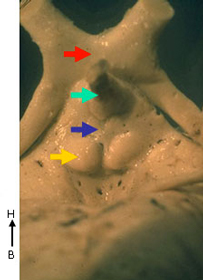 coupe sagittale Ventricule 3