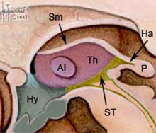 coupe sagittale Ventricule 3