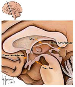 coupe sagittale Ventricule 3