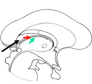 coupe sagittale Ventricule 3