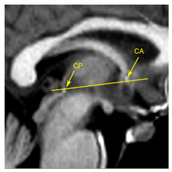 coupe sagittale Ventricule 3