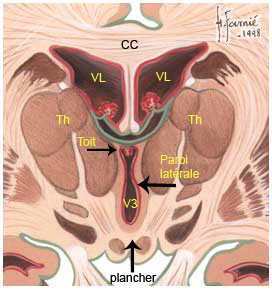 coupe coronale Ventricule 3