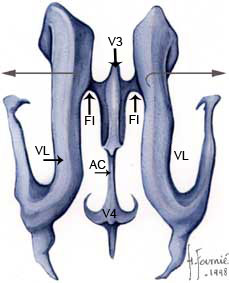 Ventricule 3