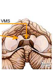 toit du quatrième ventricule